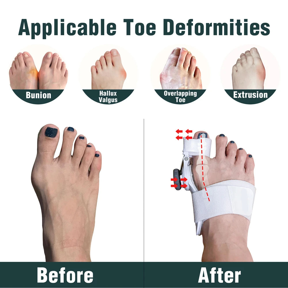 BunionRelief™ Toe Corrector
