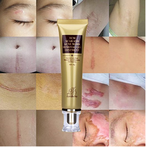 Acne Scar Removal Cream